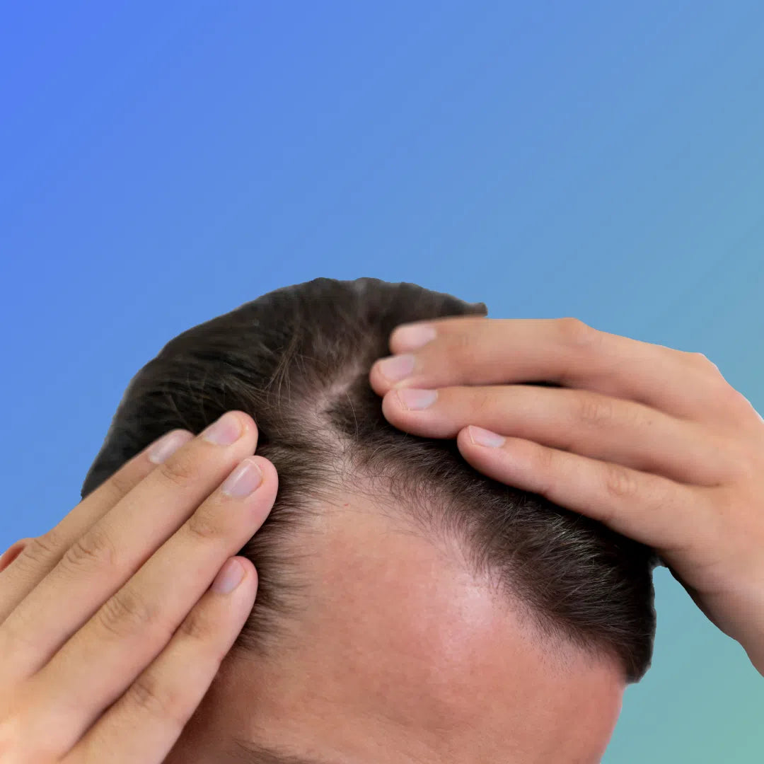Dandruff