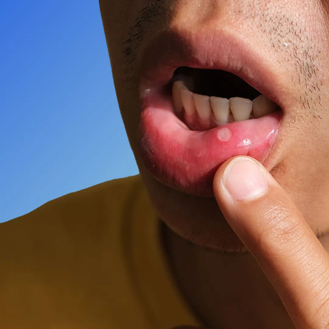 Mouth Ulcers