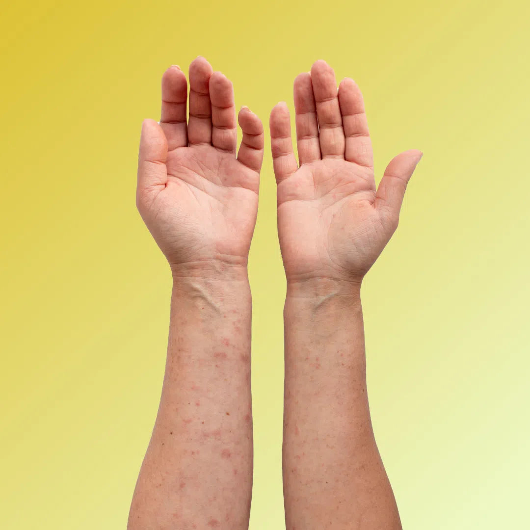 Psoriasis