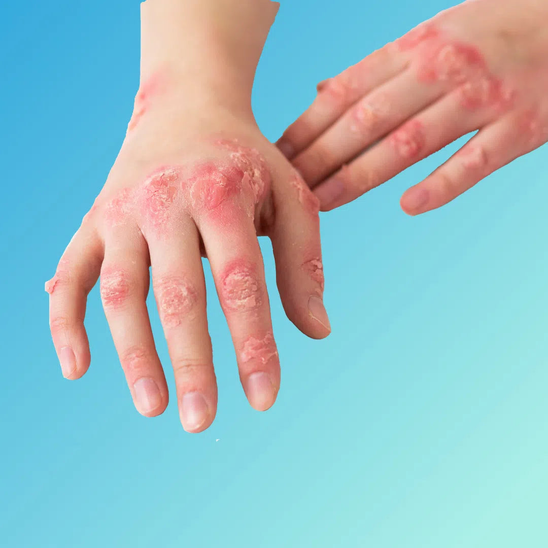 Ringworm