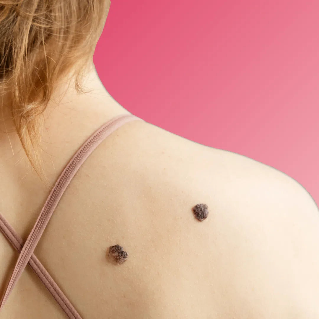 Warts & Moles
